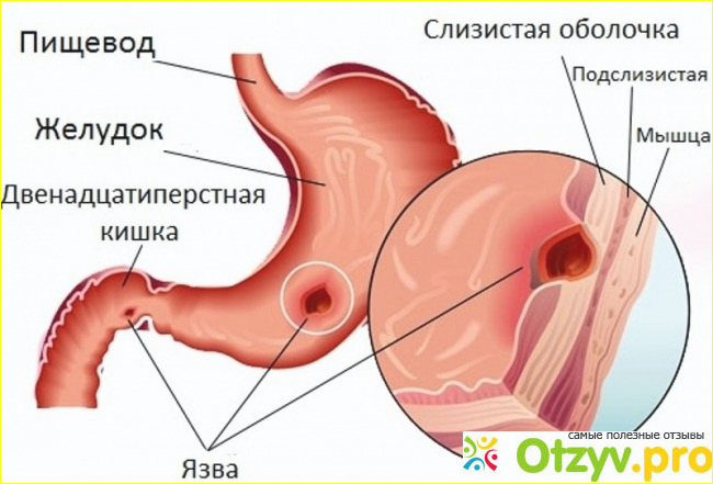 Отзыв о Язва желудка лечение схема лечения медикаментозное