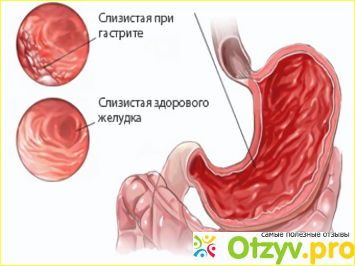 Особенности лечения при поверхностном виде гастрита.