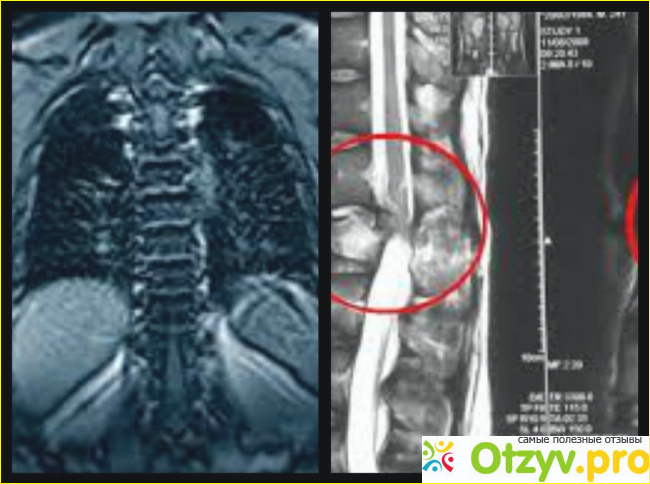 Мрт грудного отдела позвоночника что показывает фото1