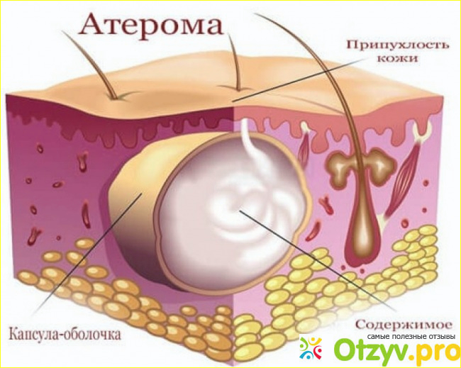 Отзыв о Атерома лечение в домашних условиях отзывы