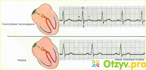 Тахикардия. Симптомы и приступ. 