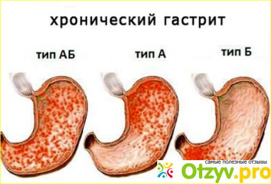 Отзыв о Как отличить гастрит с повышенной и пониженной кислотностью