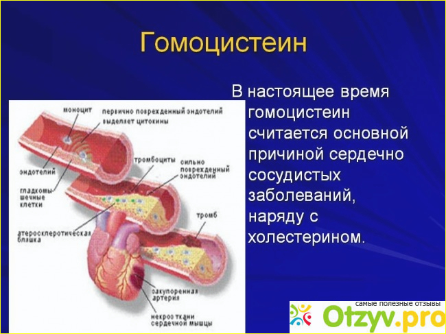 Способы нормализации уровня гомоцистеина