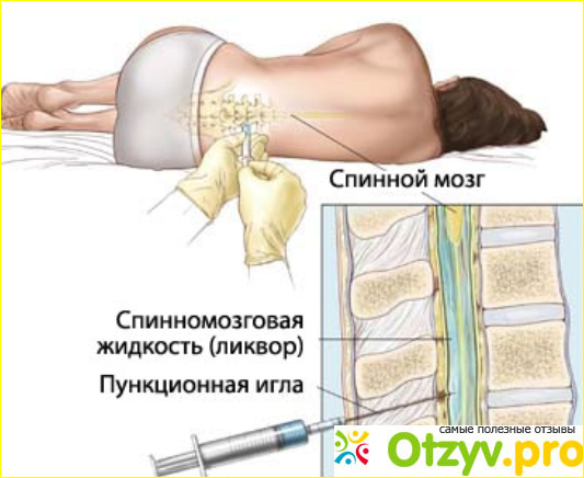 Отзыв о Люмбальная пункция показания и противопоказания