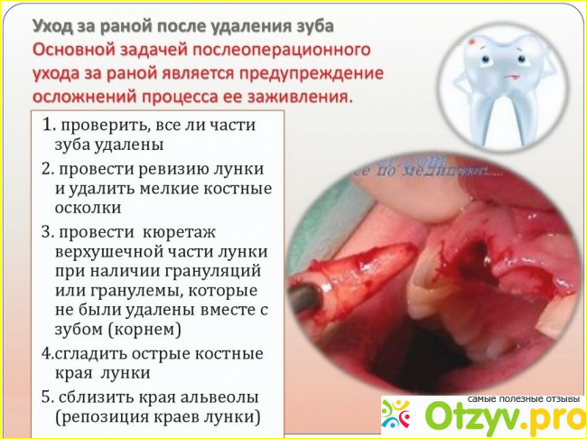 Уход за полостью рта после удаления зуба