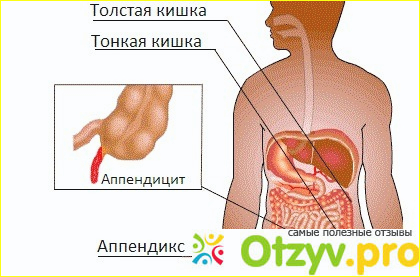 Характеристики и определение аппендицита. 