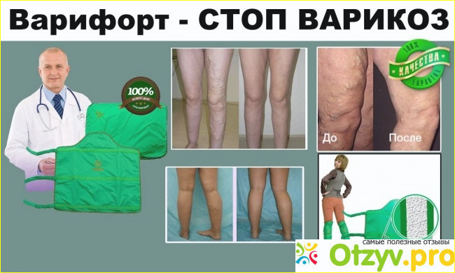 Варифорт от варикоза отзывы