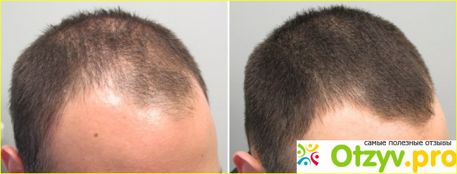 Minoxidil фото1