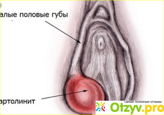 Фурункулы на интимных местах фото1