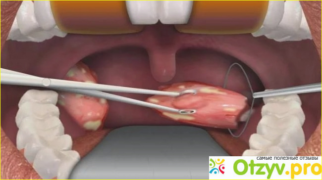 Отзыв о Холодноплазменная тонзиллэктомия отзывы