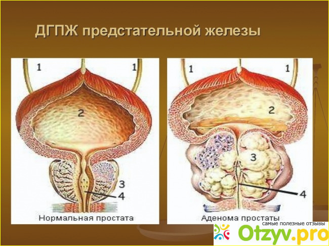 Проскар отзывы мужчин