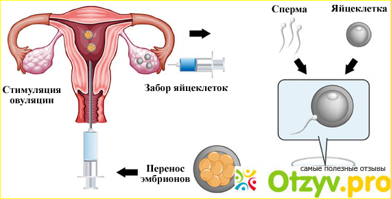 Как проводится процедура ЭКО