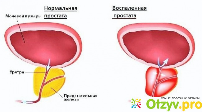 Тактика лечения простатита