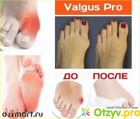 Отзыв о Фиксатор valgus pro отзывы