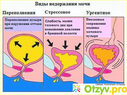 Отзыв о Недержание мочи у женщин лечение отзывы