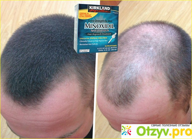 Форма выпуска Minoxidil