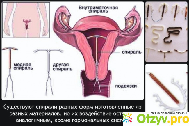 Где купить спираль мирена, стоимость