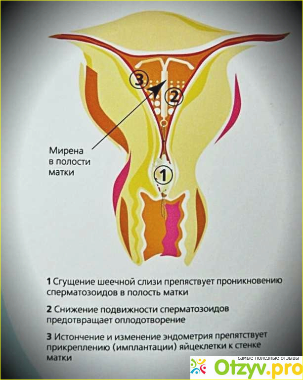 Отзыв о Мирена отзывы женщин после 45 лет