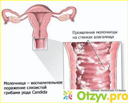 Клотримазол свечи отзывы при молочнице у женщин фото2