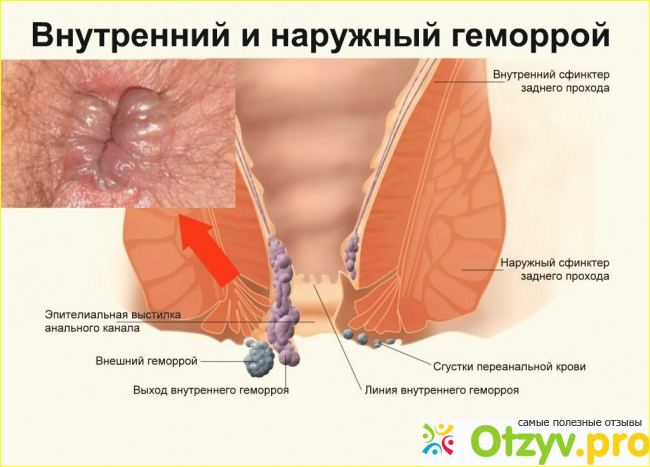 Профилактика геморроя. 