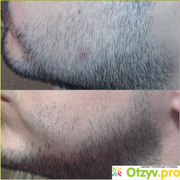 Как лечиться с помощью Minoxidil?