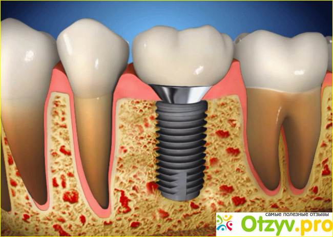 Какие зубы лучше вставить отзывы фото2