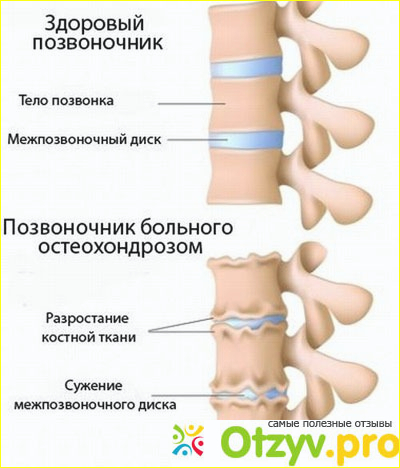 Отзыв о Лечение шейного остеохондроза народными средствами лучшими