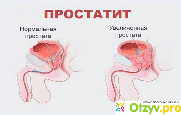 Что еще помогает победить простатит?