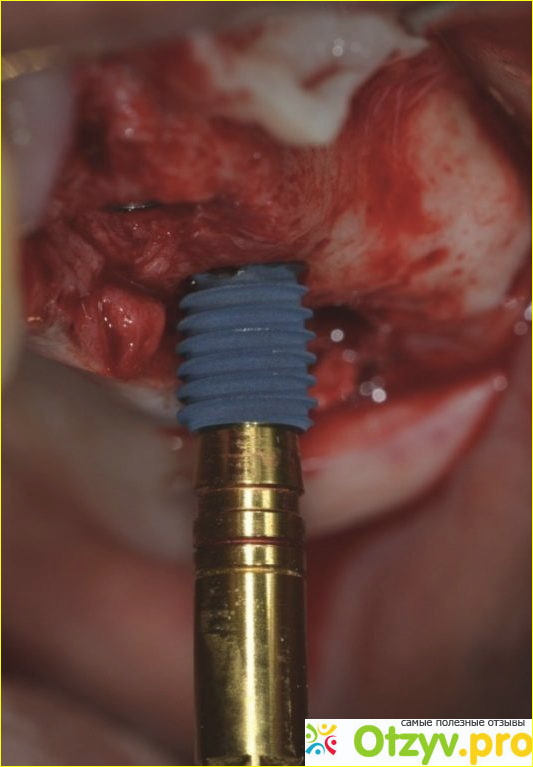 Зубные импланты отзывы пациентов отрицательные фото2