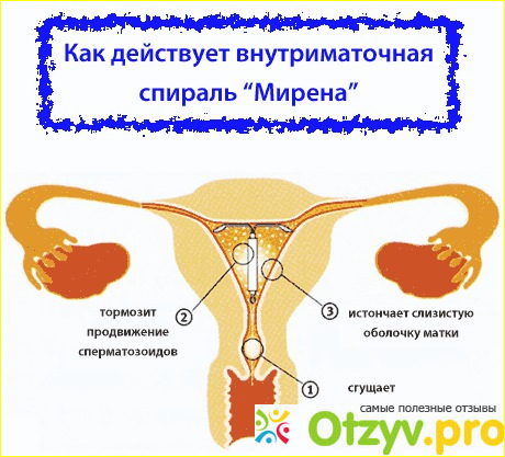 Можно ли забеременеть со спиралью Мирена?