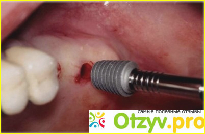 Зубные импланты отзывы пациентов отрицательные фото1