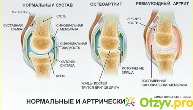 Что говорят врачи про Pantofleks