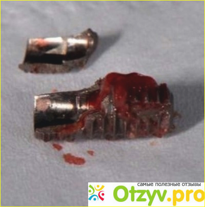 Зубные импланты отзывы пациентов отрицательные фото3