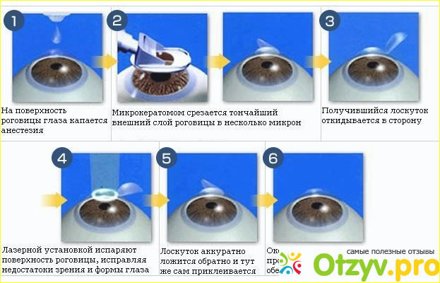 Лазерный интрастромальный кератомилез