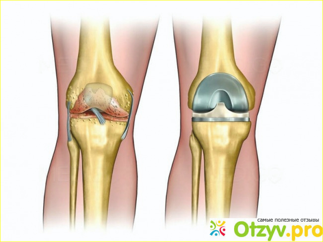 Как восстановить мениск. Эндопротез мениска коленного сустава. Мениск коленного сустава операция. Имплант мениска коленного сустава.