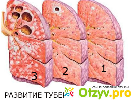 Осложнения после прививки