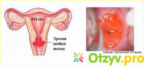 Как проходит процедура прижигания Сургитроном