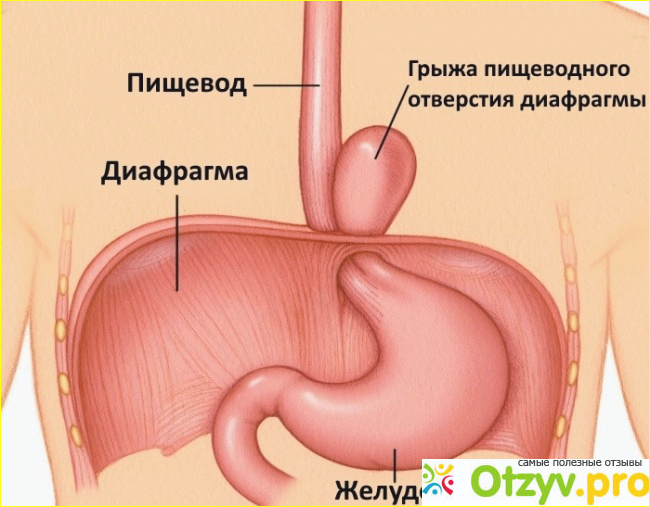 Лечение грыжи пищевода