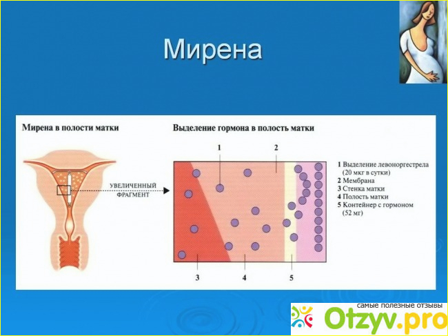 Мирена отзывы женщин фото2