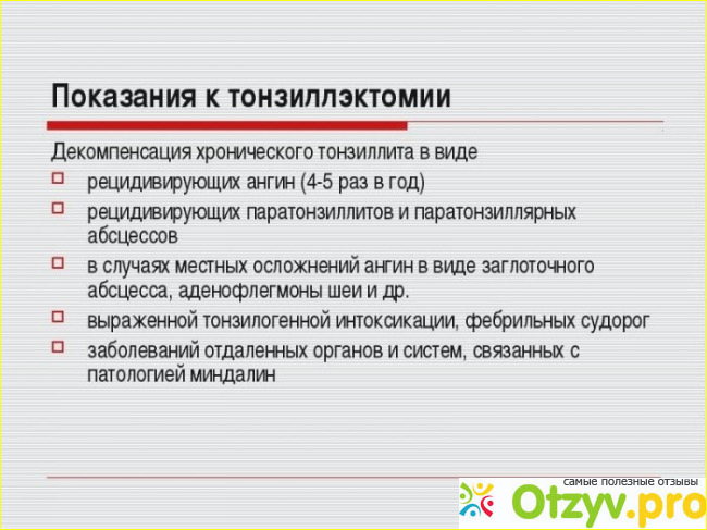 Отзыв о Танзаллэктомия радиоволновым способом. На аппарате Сургитон