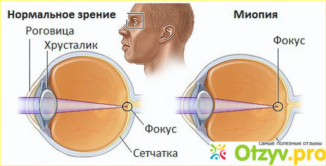 Диагностика высокой миопии