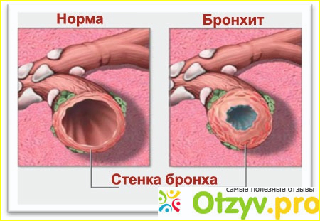 Признаки хронического бронхита.