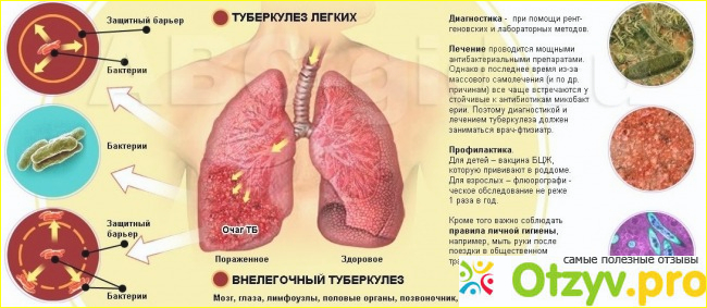 Отзыв о Туберкулёз симптомы