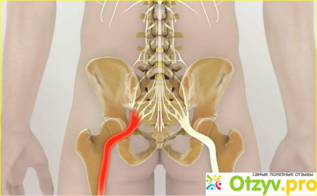 Защемление седалищного нерва. Что же это такое?