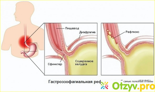 Симптомы.