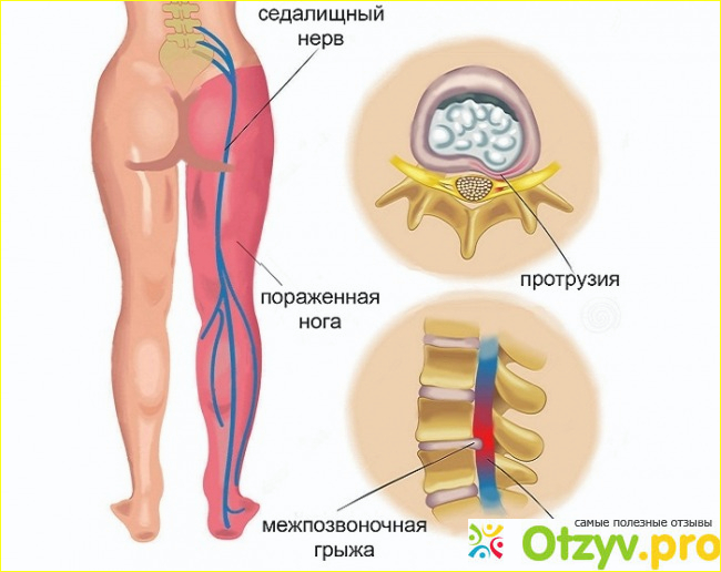 Отзыв о Защемление седалищного нерва