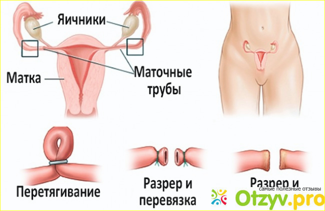 Перевязка труб у женщин последствия отзывы фото1