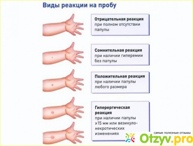 Сколько дней нельзя мочить. Реакция манту норма у детей 2 года норма. Реакция манту норма у детей 5-6.