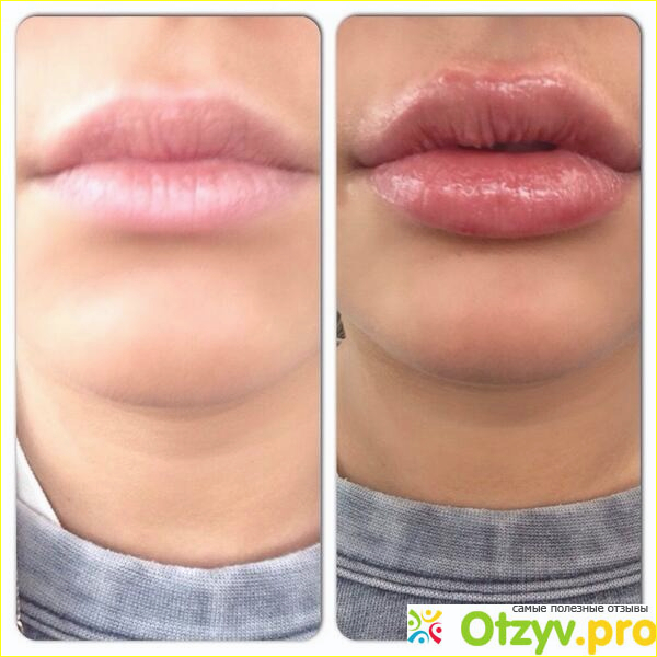 Увеличение губ Juvederm