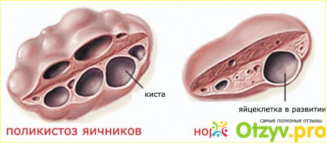 Что же это такое - поликистоз яичников?